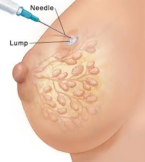Breast biopsy.
A biopsy is a test used to help di...