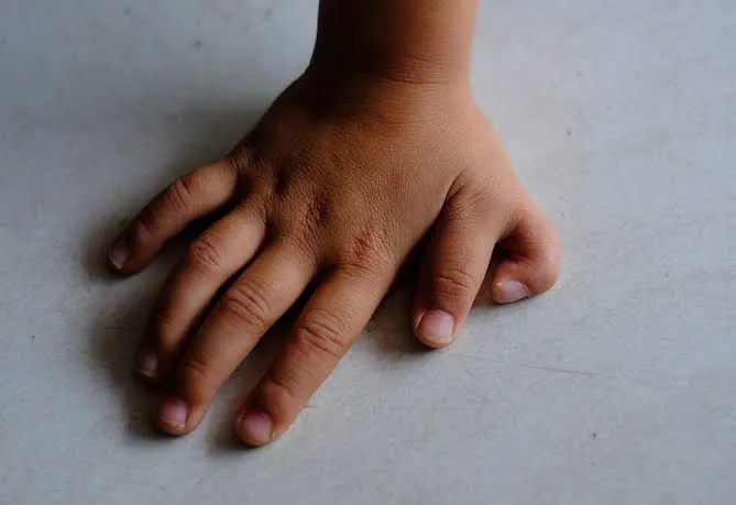 Polydactyly is a condition where someone is born w...