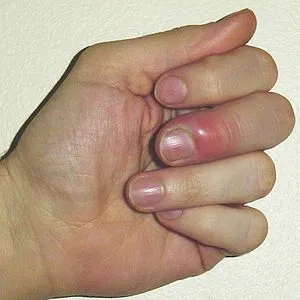 Paronychia is an infection of the skin around your...