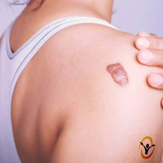 A keloid (key-loid) is a type of raised scar. Unli...