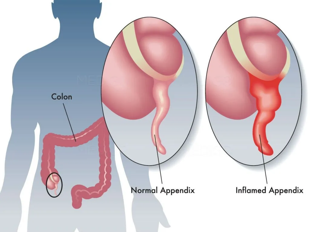 Open appendicectomy is a surgical procedure to rem...