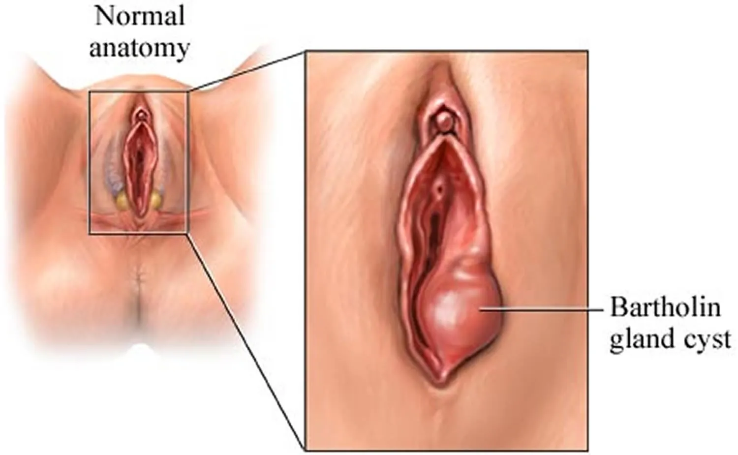 The Bartholin's glands are located on each side of...