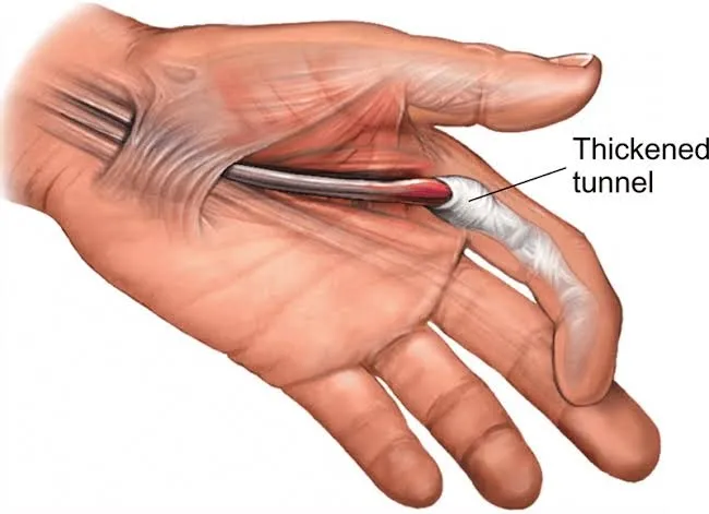 Trigger finger is a condition in which one of your...