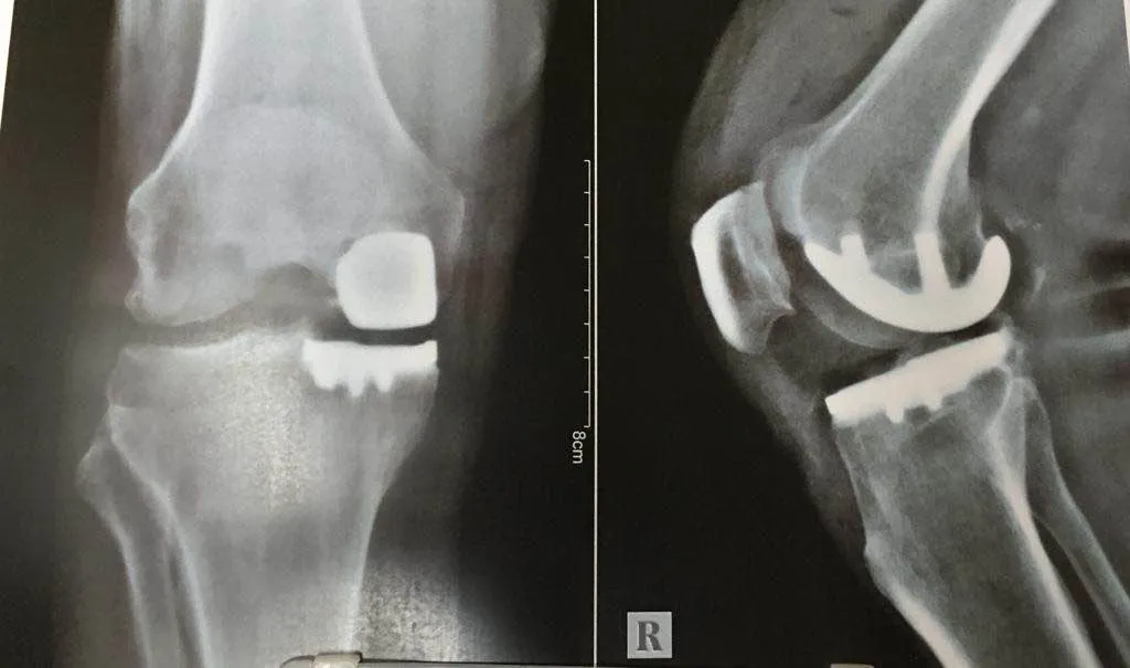 “UNICONDYLAR KNEE REPLACEMENT” म्हणजे काय?
सोप्य...