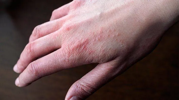 Eczema typically causes areas of a person's skin t...