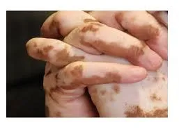 Leucoderma... an Ayurveda Aspect
Shwitra or Shwe...