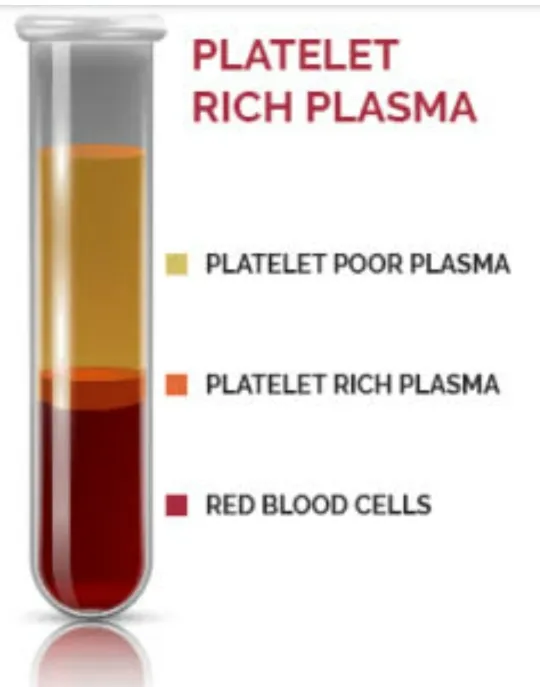 PLATELET RICH PLASMA obtained from patient's own b...