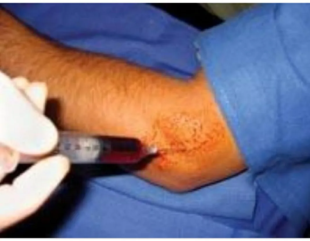 Platelet Rich Plasma can be given in tennis elbow,...