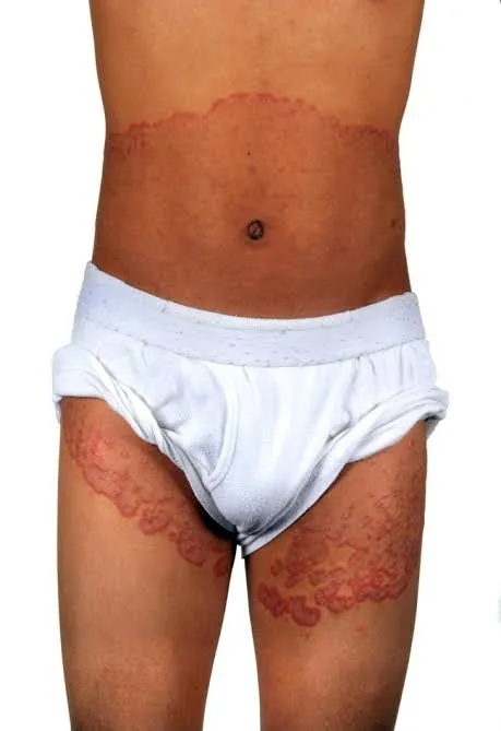 Jock itch (tinea cruris) is a fungal infection tha...