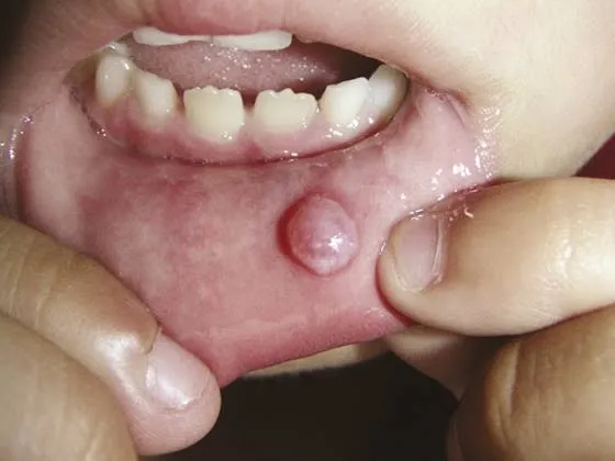Mucocele
It's natural to be a little worried whe...