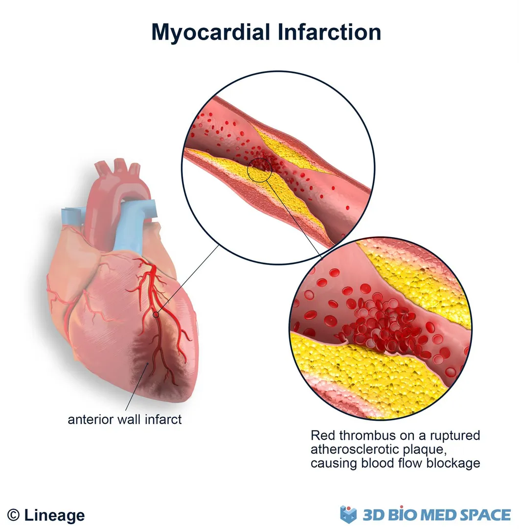 MYOCARDIAL INFARCTION
Medical name of a Heart atta...