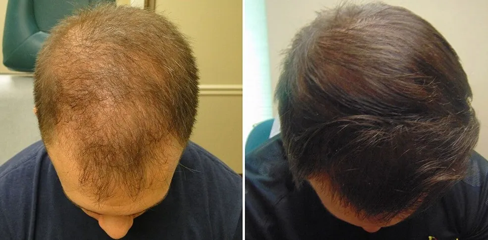 Platelet-rich plasma (PRP) Therapy
PRP Treatment ...