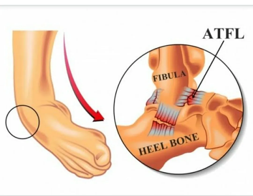 LIGAMENTS PROVIDE STABILITY TO JOINT.TWISTING CAN ...