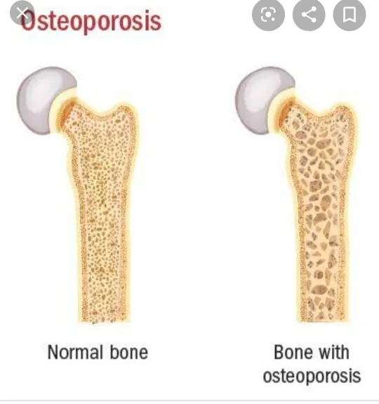 OSTEOPOROSIS is reduced bone density, seen more in...