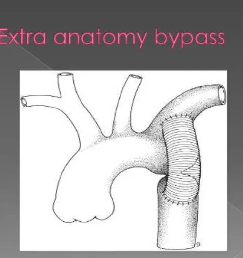 Operated a young boy of 15 yrs . Who had narrow in...