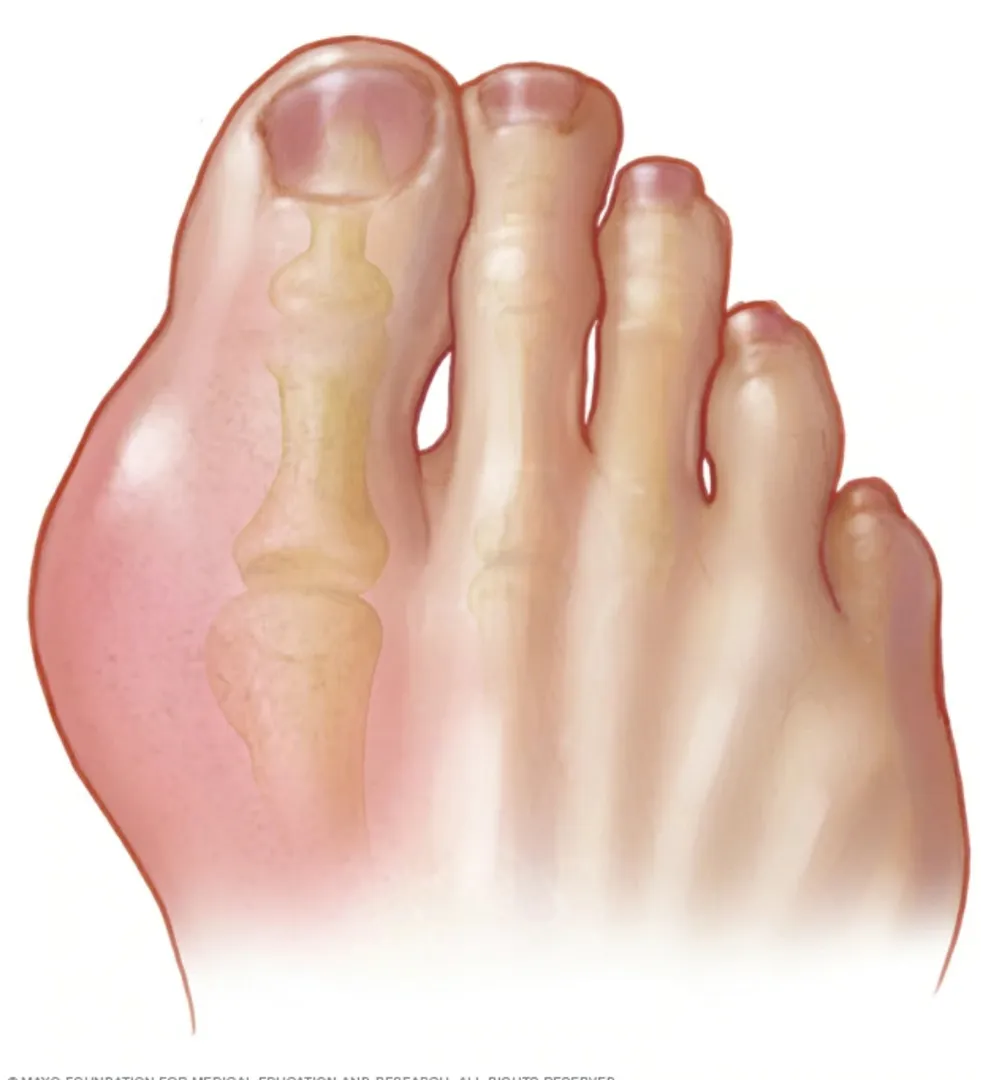 WHAT IS GOUT ?
IT IS A FORM OF ARTHRITIS CHARACTER...