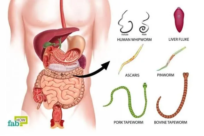 Intestinal worms, also known as parasitic worms, a...