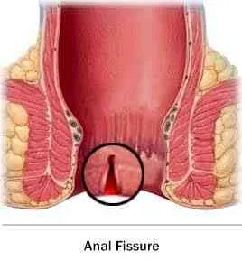 Anal fissure
Early diagnosed fissure healed itself...