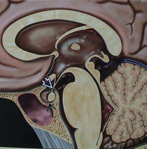 Pituitary Tumors - Surgery for tumors arising from...