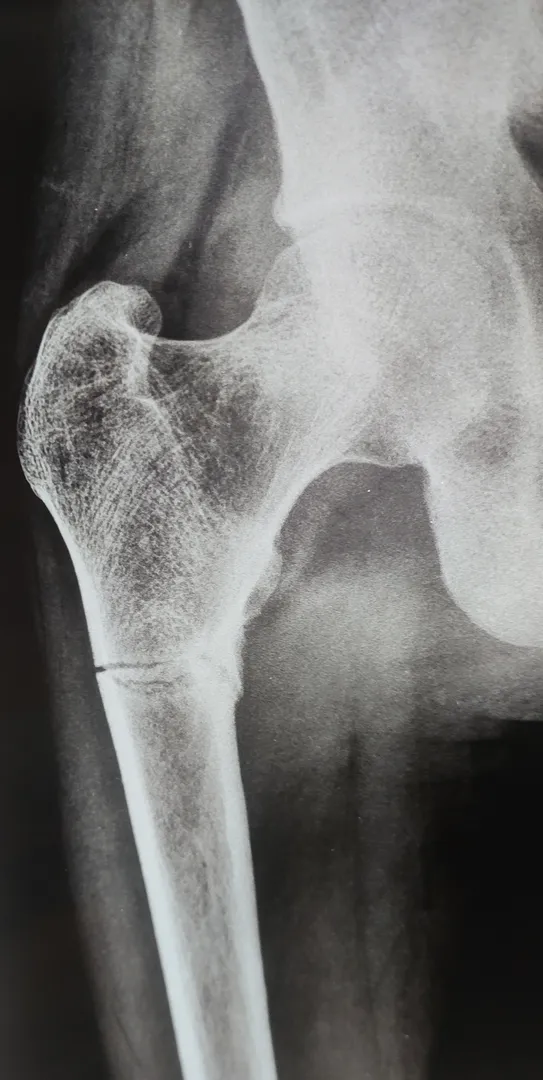 X RAY CAN IDENTIFY DECREASE IN BONE DENSITH HENCE ...