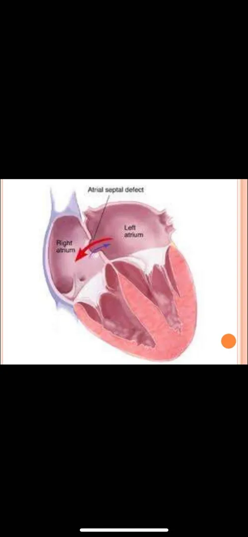 Hole in the heart . Part 1.
Atrial septal defect ...