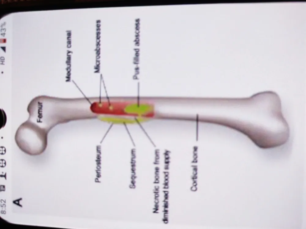 Chronic Osteomyelitis.
It is a sequele of an acut...