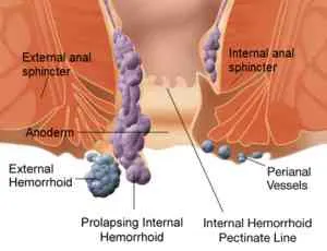 Piles also called haemorrhoids, are vascular struc...