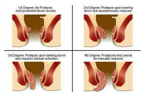 Piles are collections of tissue and vein that beco...