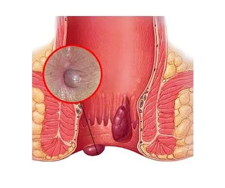 Most perianal hematomas resolve on their own withi...