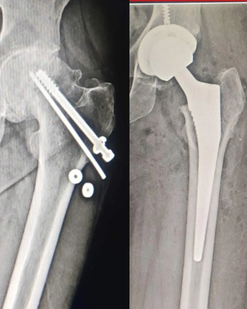 Hip arthritis after trauma is painful condition w...