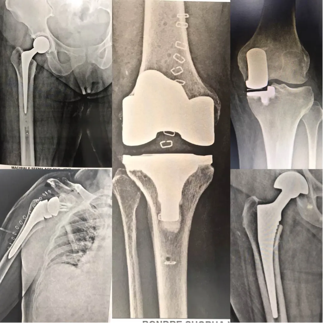 Robotic knee replacement surgery
Hip replacement ...