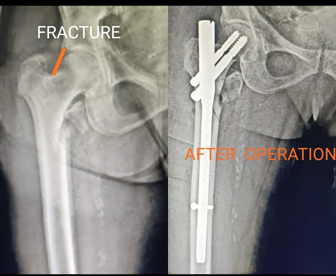Minor fall can lead to hip fracture in elderly peo...