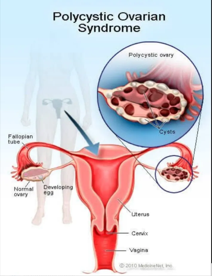 Polycystic ovarian syndrome-understand the problem...