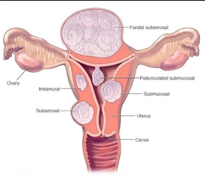 Fibroids- A benign tumor of uterus and commonest c...