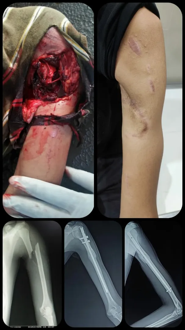 OPEN FRACTURE WITH BLEEDING NEEDS IMMEDIATE PROPER...