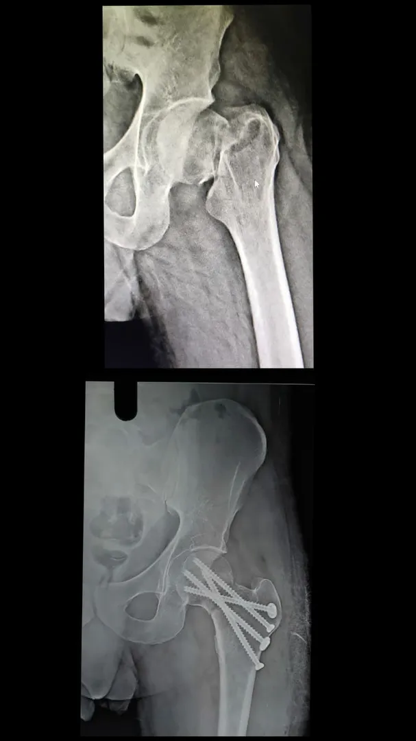 WE AT TANISH HOSPITAL ALWAYS TRY FOR HIP PRESERVIN...