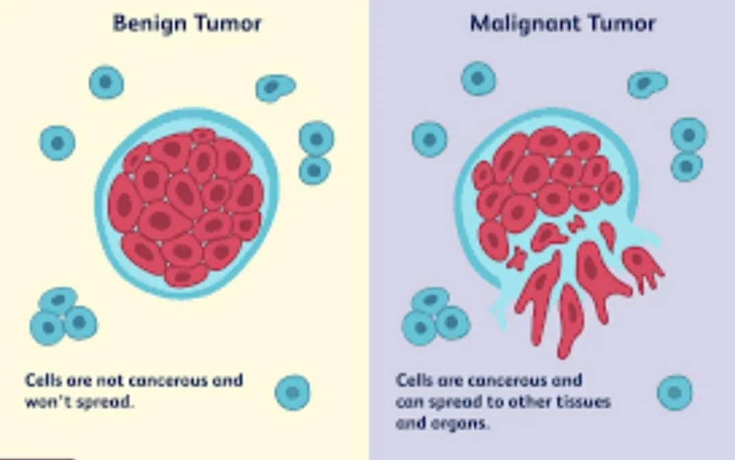 TUMORS ARE OF TWO TYPES- BENIGN IN WHICH CELLS ARE...