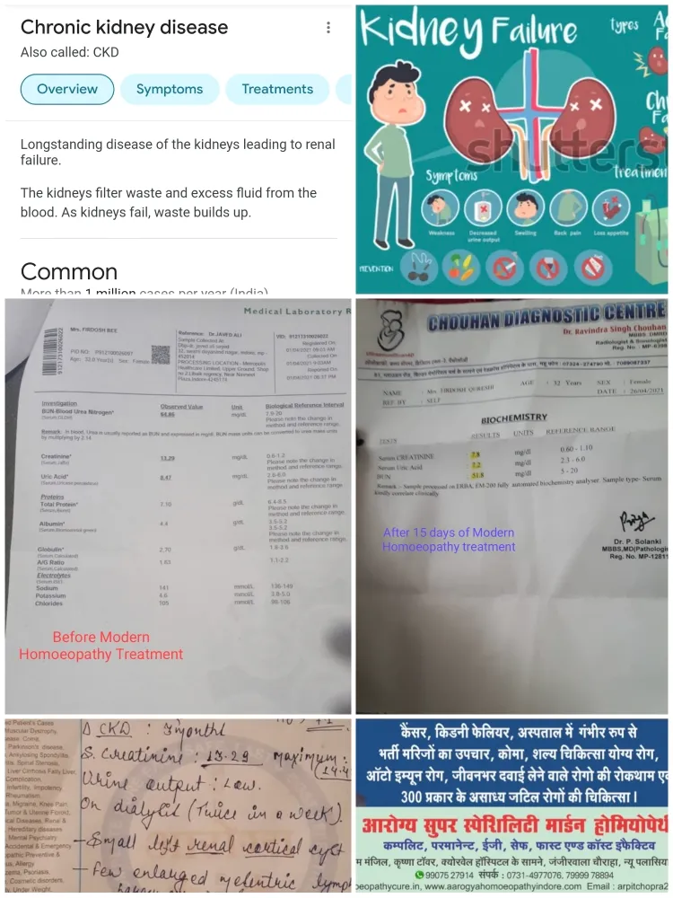 👆CKD CREATININE 13.29 TO 7.8 mg/dI REDUCED IN LES...