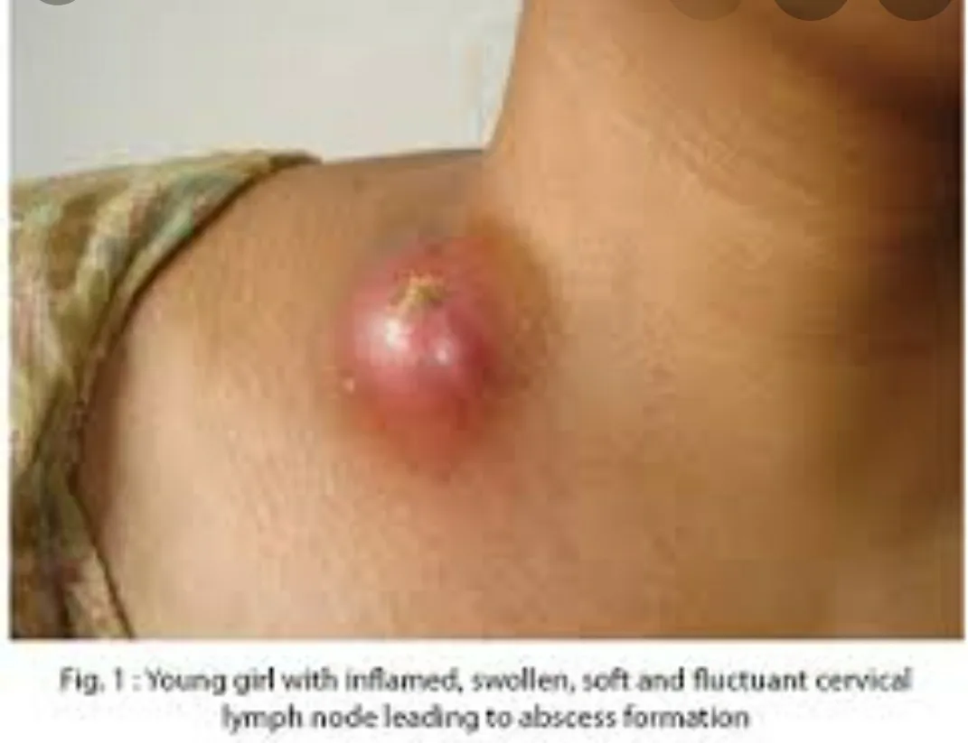 Tubeculosis is infection by tuberculi bacteria lea...