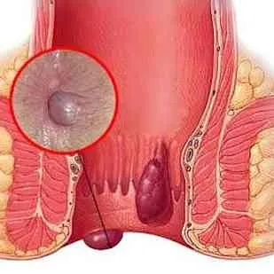 Dr Phapale Hospital
Centre for Piles & General Sur...