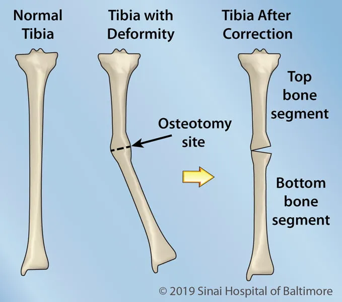 Total Knee Replacement..a surgery that turns aroun...