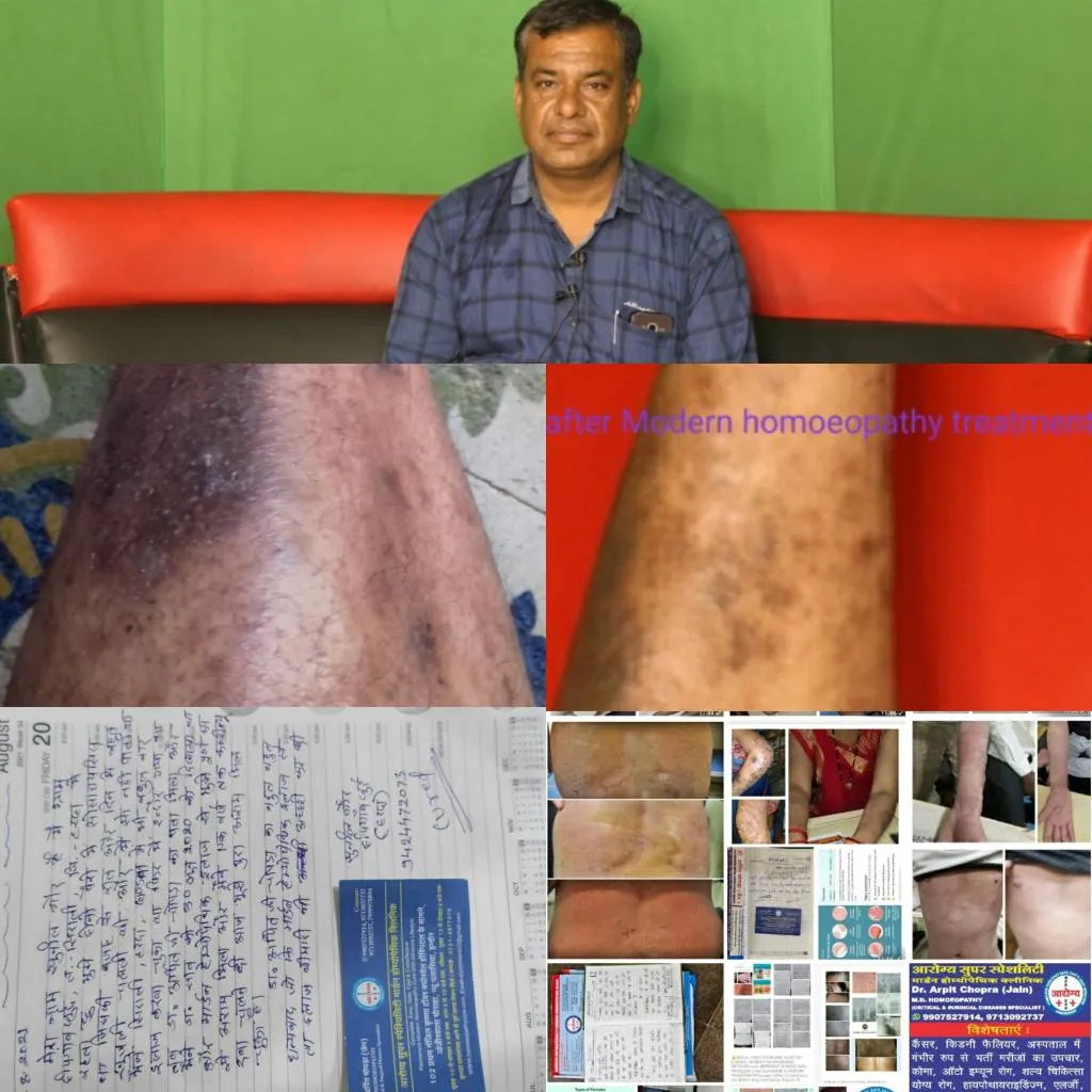 Skin Psoriasis Cured By Dr Arpit Chopra's Super Sp...