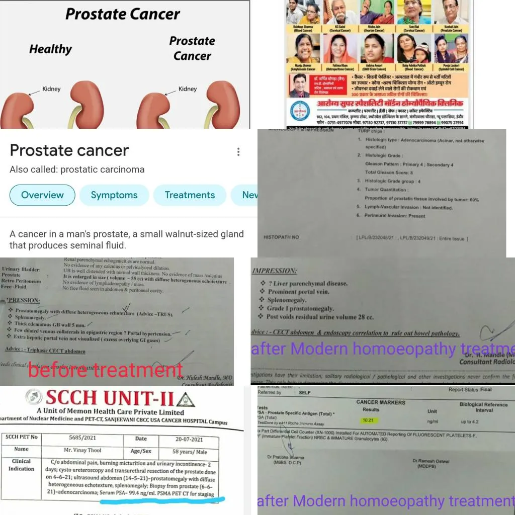 PROSTATE CANCER RESPONDED WITH RAISED PSA 99 ng/ml...