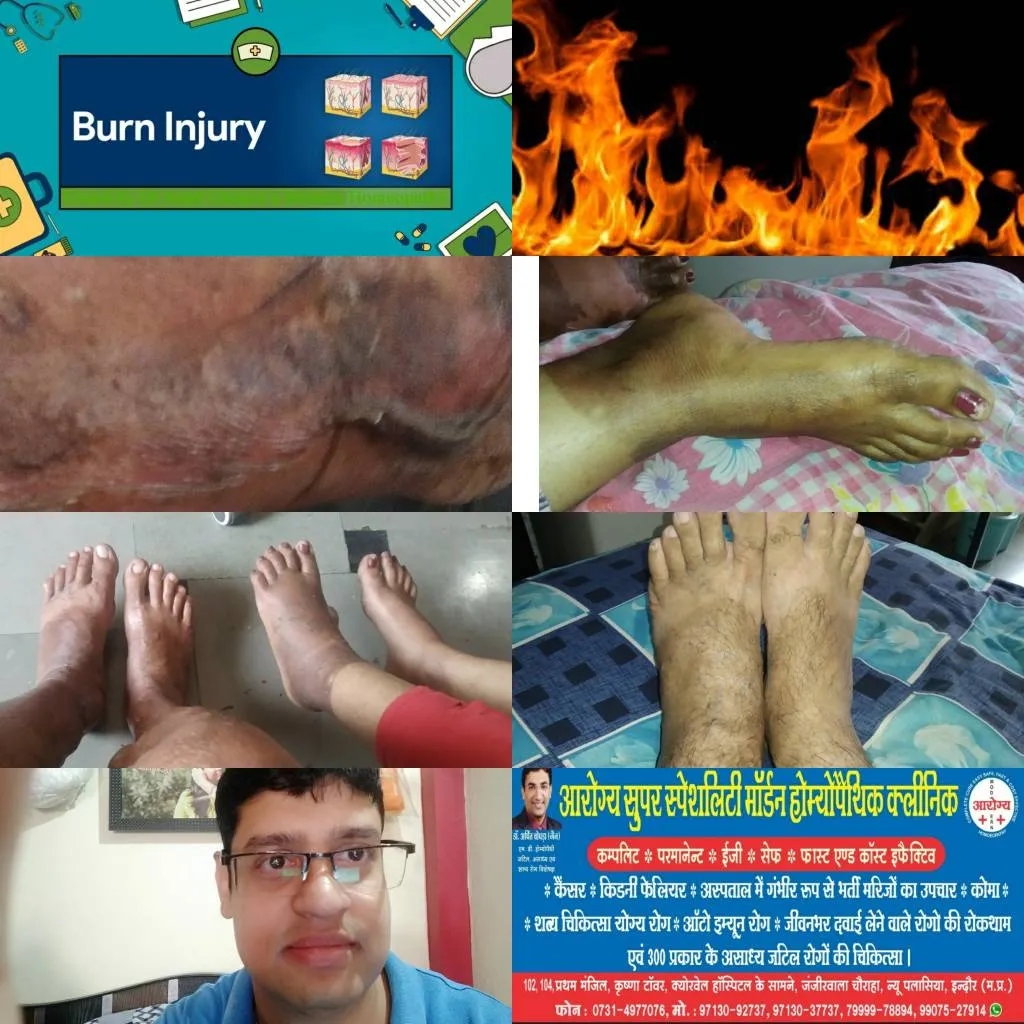 👆BURN INJURY cured fast by Dr Arpit Chopra Jain's ...