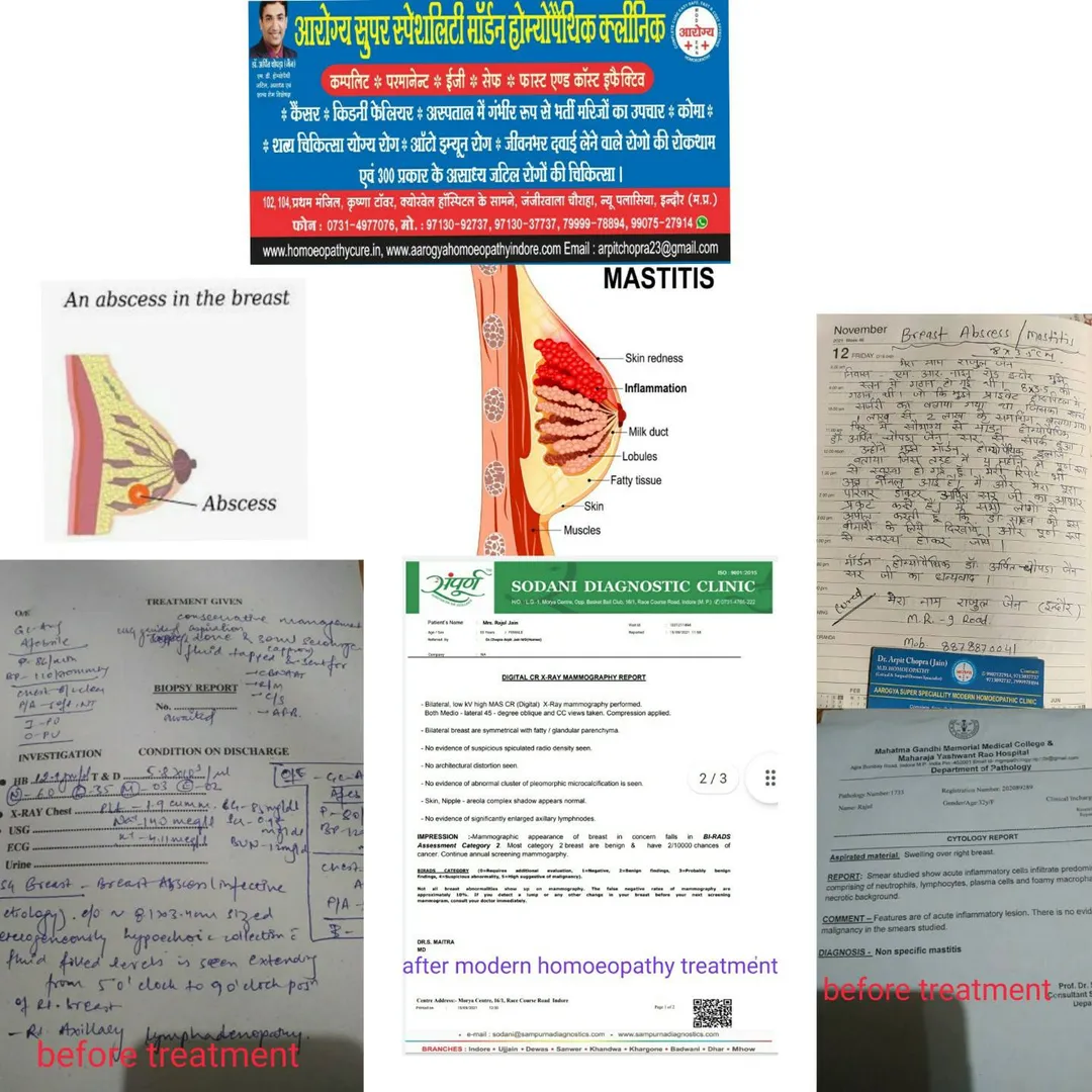 👆BREAST ABSCESS 8 1x3.4CM WITH MASTITIS NODULE lar...