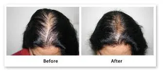 Best Hairfall Specialist in Rajouri Garden -
New...