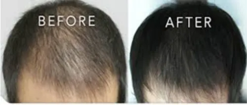 Best Hairfall Specialist in Ramesh Nagar -
Hair ...