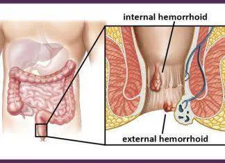 Symptoms of Piles:-
Signs and symptoms of hemorrh...