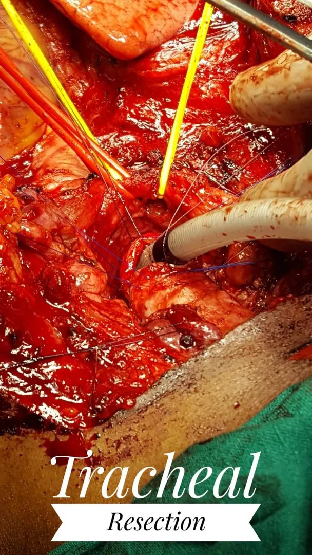 Why it is good to get the treatment for lung cance...