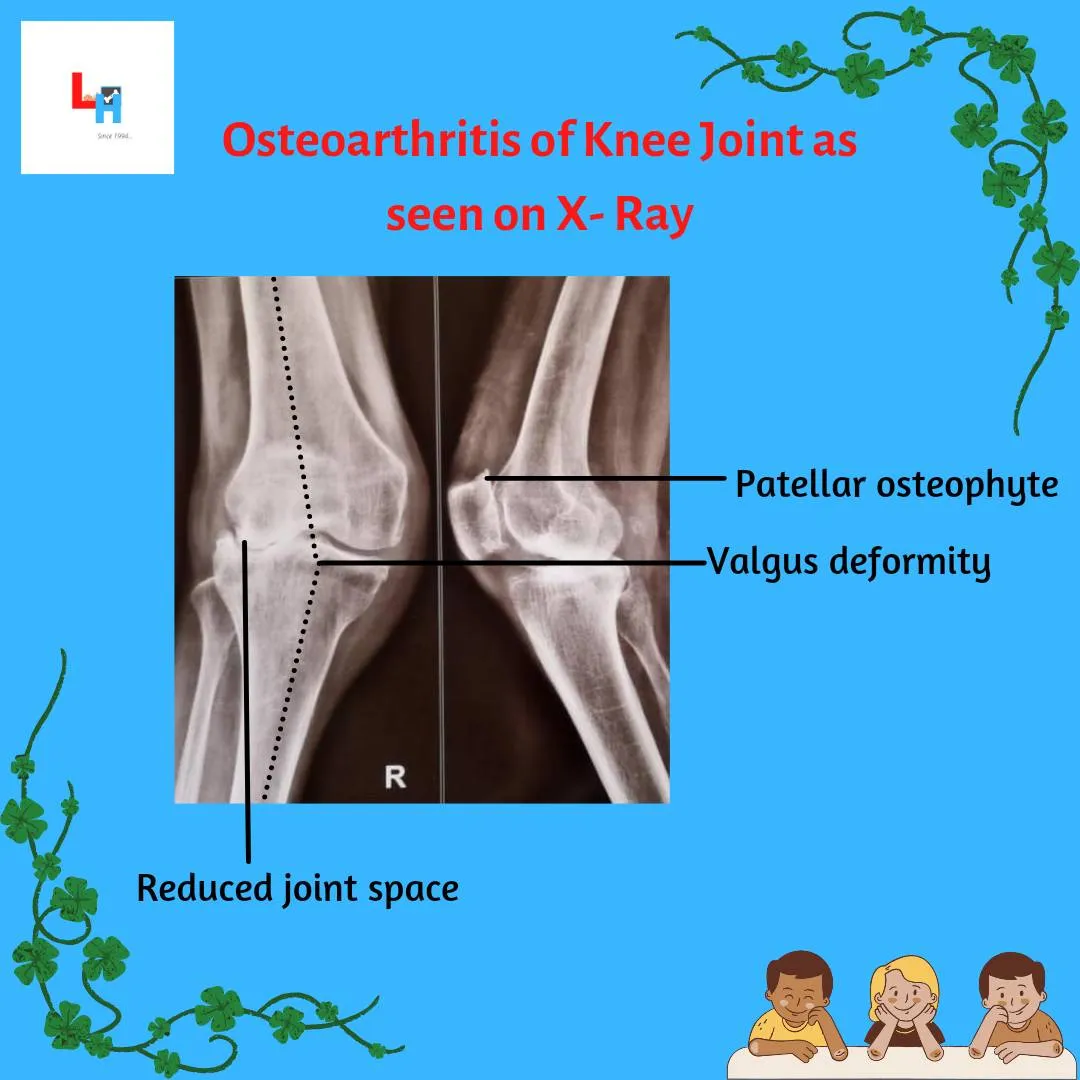 - Osteoarthritis of Knee Joint is a degenerative d...